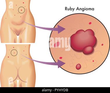 vector medical illustration of the symptoms of ruby angioma Stock Vector
