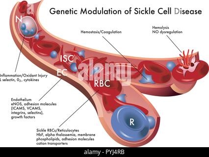 medical illustration of the genetic modulation of sickle cell disease Stock Vector