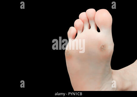 foot corn isolated on black background with clipping path Stock Photo