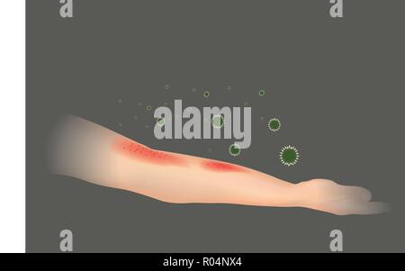 Skin allergy. The appearance of rash in the arm. Illustration. Stock Vector