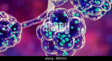 Staphylococcal pneumonia. Computer illustration of Staphylococcus aureus bacteria inside the alveoli of the lungs, causing pneumonia. Stock Photo