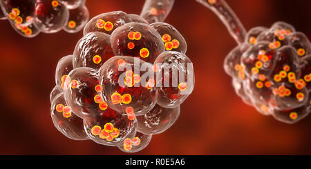 Staphylococcal pneumonia. Computer illustration of Staphylococcus aureus bacteria inside the alveoli of the lungs, causing pneumonia. Stock Photo