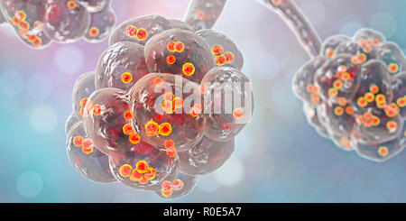 Staphylococcal pneumonia. Computer illustration of Staphylococcus aureus bacteria inside the alveoli of the lungs, causing pneumonia. Stock Photo