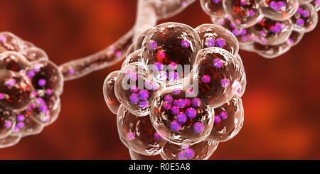 Staphylococcal pneumonia. Computer illustration of Staphylococcus aureus bacteria inside the alveoli of the lungs, causing pneumonia. Stock Photo