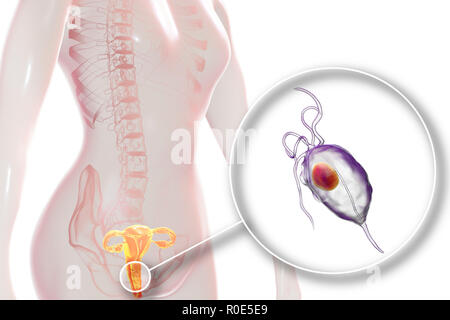 Trichomoniasis, illustration. Computer illustration of the female reproductive system and the parasitic microorganism Trichomonas vaginalis, which is the causative agent of trichomoniasis. Trichomoniasis is a common cause of vaginitis and is a sexually transmitted disease. Stock Photo