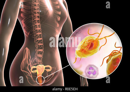 Trichomoniasis, illustration. Computer illustration of the female reproductive system and the parasitic microorganism Trichomonas vaginalis, which is the causative agent of trichomoniasis. Trichomoniasis is a common cause of vaginitis and is a sexually transmitted disease. Stock Photo