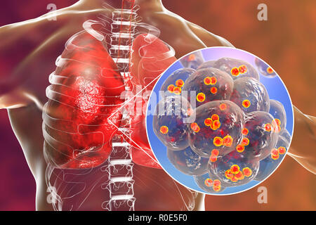 Staphylococcal pneumonia. Computer illustration of Staphylococcus aureus bacteria inside the alveoli of the lungs, causing pneumonia. Stock Photo