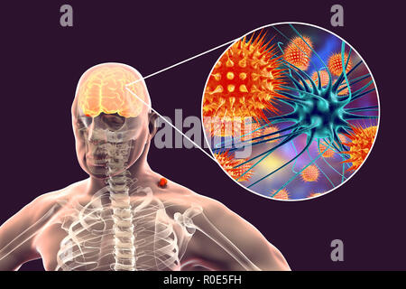 Tick-bourne encephalitis, computer illustration. Tick- borne encephalitis (inflammation of the brain) covers a range of illnesses ranging from a severe paralytic encephalitis, which occurs in Siberia and is transmitted by Ixodes persulcatus, to a less paralytic encephalitis, which is found in central Europe and transmitted by Ixodes ricinus. Agricultural and forestry workers are most frequently affected, as the foci of infection are in and around forest areas, the vertebrate maintenance hosts being rodents and ground-living birds. Stock Photo