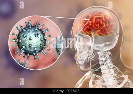 Encephalitis caused by varicella zoster virus (VZV), computer illustration. VZV, a virus from the Herpesviridae family, is the causative agent of chickenpox and shingles. Encephalitis (inflammation of the brain) is one of complications of chickenpox infection. Stock Photo