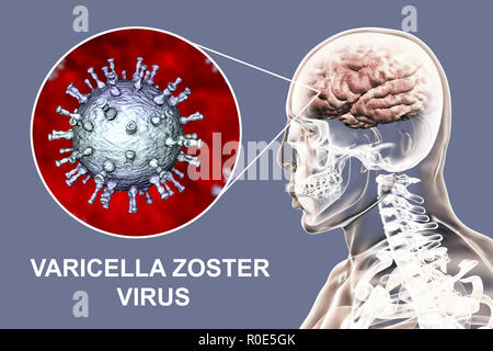 Encephalitis caused by varicella zoster virus (VZV), computer illustration. VZV, a virus from the Herpesviridae family, is the causative agent of chickenpox and shingles. Encephalitis (inflammation of the brain) is one of complications of chickenpox infection. Stock Photo