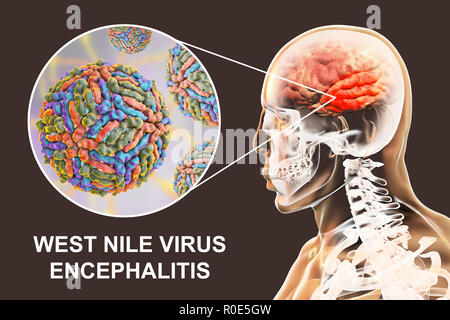 Encephalitis caused by West Nile virus, computer illustration. West Nile virus (WNV) is known to cause encephalitis (inflammation of the brain) in humans. The WNV belongs to the flavivirus group, which are RNA (ribonucleic acid) viruses that are surrounded by an outer protein envelope. WNV is transmitted by mosquitoes and infects both humans and animals. Symptoms can range from a mild fever to spontaneous bleeding of the skin and circulatory failure, which are often fatal. Stock Photo