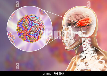 Encephalitis caused by West Nile virus, computer illustration. West Nile virus (WNV) is known to cause encephalitis (inflammation of the brain) in humans. The WNV belongs to the flavivirus group, which are RNA (ribonucleic acid) viruses that are surrounded by an outer protein envelope. WNV is transmitted by mosquitoes and infects both humans and animals. Symptoms can range from a mild fever to spontaneous bleeding of the skin and circulatory failure, which are often fatal. Stock Photo