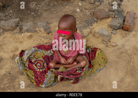 A malnourished child in North Kivu province in eastern Democratic Republic of Congo Stock Photo