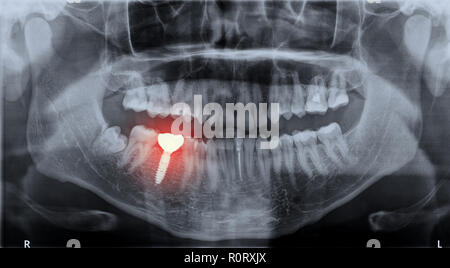 Panoramic dental x-ray image mouth of adult man and single dental implant with crown attached used for tooth replacement, with indicated with painful area Stock Photo
