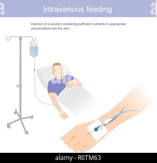 Injection of solution containing sufficient nutrient in appropriate concentration into the vein. Illustration graphic. Stock Vector