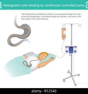 The feeding tube controlled by electronic pump passes through the nose, throat and oesophagus, continues through the stomach, and ends in the first se Stock Vector