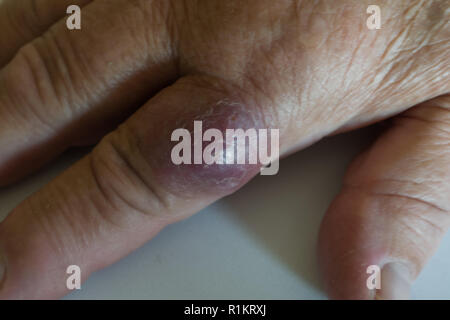 index finger infected by a cat scratch Stock Photo