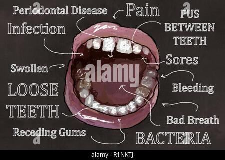 Ugly Teeth, open Mouth and Symptoms of Gum Disease. Illustrated on Blackboard in Classic Drawing Style Stock Photo