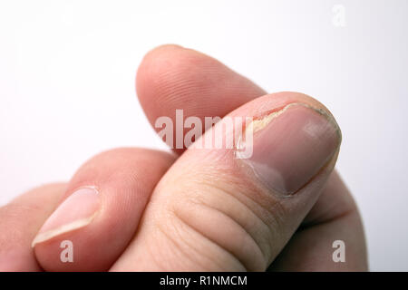 Close Up of Nail Fungus Infection on the Thumb Finger Stock Image - Image  of dermatophyte, closeup: 131529121