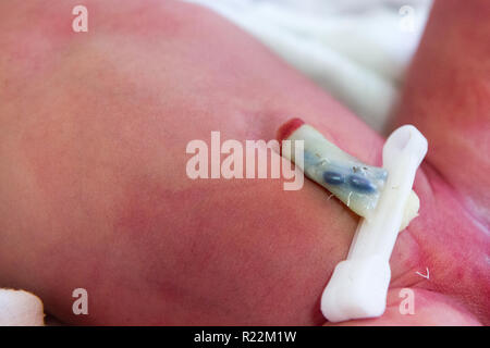 a clamped umbilical cord stump of a newborn baby Stock Photo