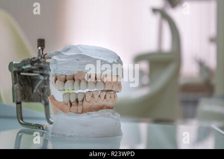 Gypsum Stomatologic human jaws. Ceramic-metal crown on plaster model on blurred background of dental office. Stock Photo