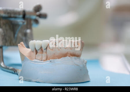 Gypsum Stomatologic human jaws. Ceramic-metal crown on plaster model on blurred background of dental office. Stock Photo