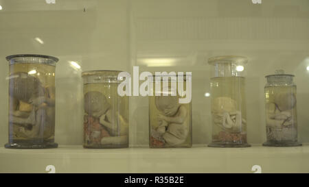Anatomical preserved human specimens, ugliness, anomalies. Human parts of the body preserved in formalin for scientific study by scientists. Exhibition items in autopsy room. Stock Photo