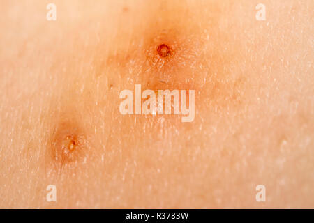 Close up of Molluscum Contagiosum also called water wart. Stock Photo