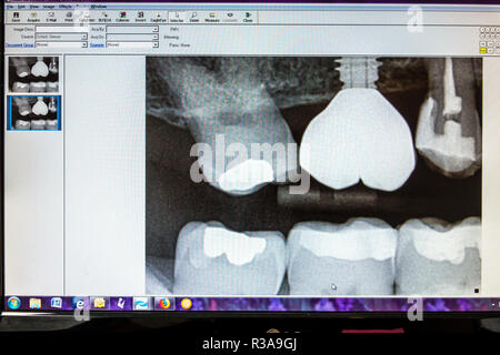 Miami Beach Florida,dentist office,xray x-ray xrays x-rays,tooth teeth,implant root canal screw crown filling,FL181030027 Stock Photo