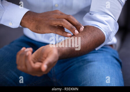 Close-up Of An African Man Scratching His Hand Stock Photo