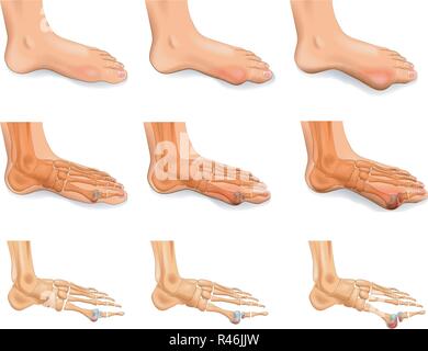 vector illustration of arthritis, arthrosis of the big toe Stock Vector