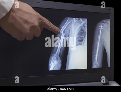 On the monitor screen is displayed an xray of fracture of a hand with the hand of a doctor pointing to a fracture. The second image on the screen is h Stock Photo