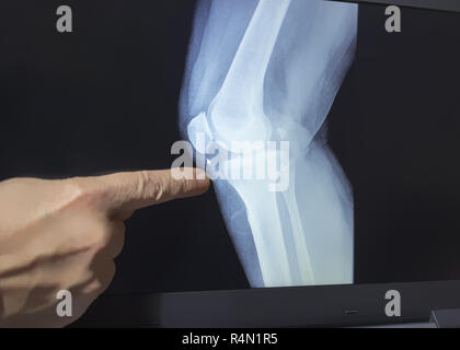 An xray of a knee with a hand of doctor witch pointing to a fracture Stock Photo