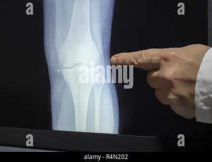 An xray of a knee with a hand of doctor witch pointing to a fracture Stock Photo