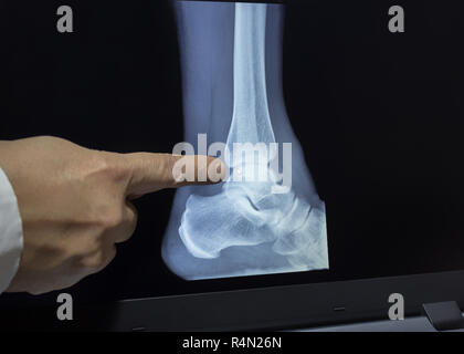 An xray of a heel with a hand of doctor witch pointing to a fracture Stock Photo