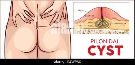 https://l450v.alamy.com/450v/r4wp6x/vector-illustration-pilonidal-cyst-formation-r4wp6x.jpg