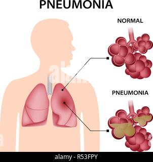 Lung infection pneumonia 3d medical vector illustration on white ...