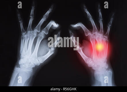 Human's hand's x ray highlighted in red Stock Photo