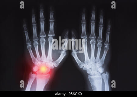 Human's hand's x ray highlighted in red Stock Photo