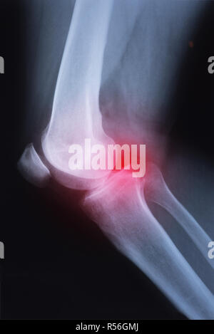 Medical x-ray knee joint image with arthritis ( Gout , Rheumatoid arthritis , Septic arthritis , Osteoarthritis knee ) Stock Photo