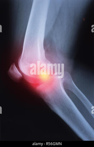 Medical x-ray knee joint image with arthritis ( Gout , Rheumatoid arthritis , Septic arthritis , Osteoarthritis knee ) Stock Photo