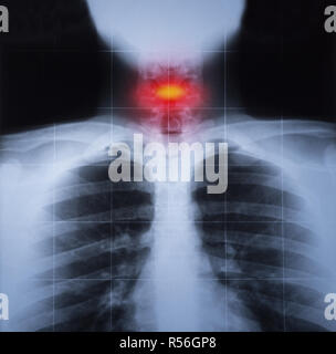 X ray image of chest and cervical trauma highlighted in red Stock Photo