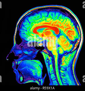 Coloured magnetic resonance imaging (MRI) scan of a sagittal section through a patient's head showing a healthy human brain. Stock Photo
