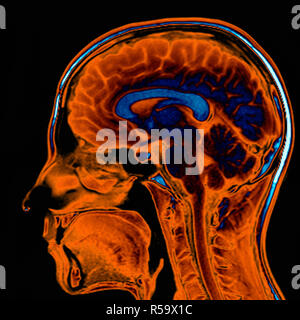 Coloured magnetic resonance imaging (MRI) scan of a sagittal section ...