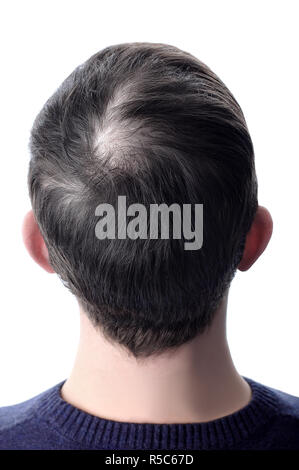 Men S Hair After Using Cosmetic Powder For Hair Thickening White