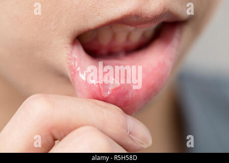 Woman suffer from aphtha on mouth Stock Photo