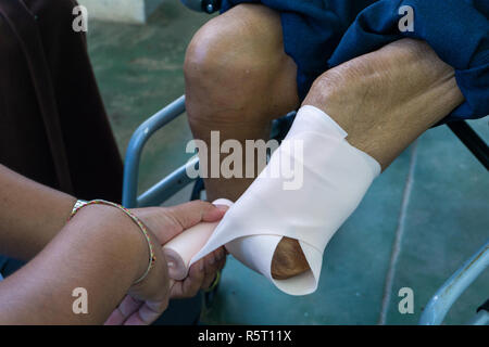 elastic bandaging of below knee stump Stock Photo