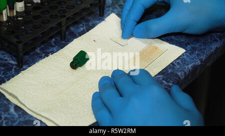 Slide peripheral blood smear method. Doctor examines and analyzes blood samples in the laboratory Stock Photo