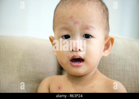 Baby boy with chicken pox Stock Photo - Alamy