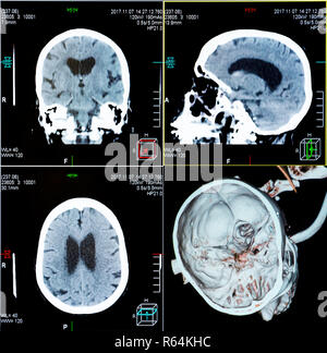 Magnetic resonance imaging (MRI) scan - CT scans of human head on a ultrasound computer monitor. Stock Photo